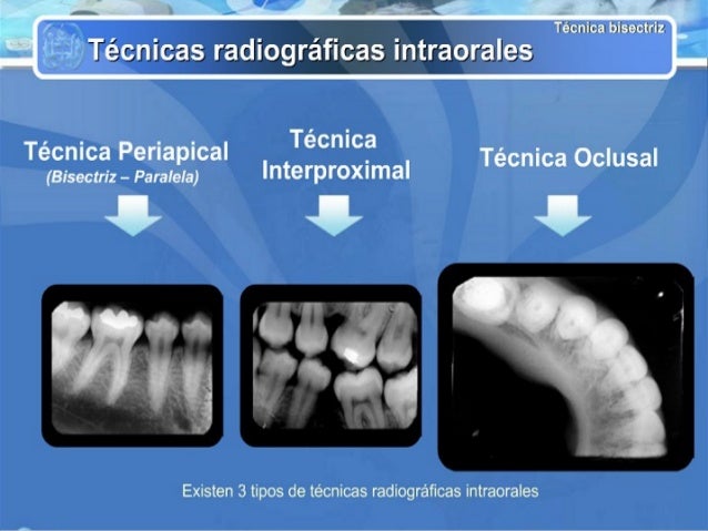 tecnicas radiograficas intraorales